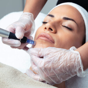 Microneedling with PRP