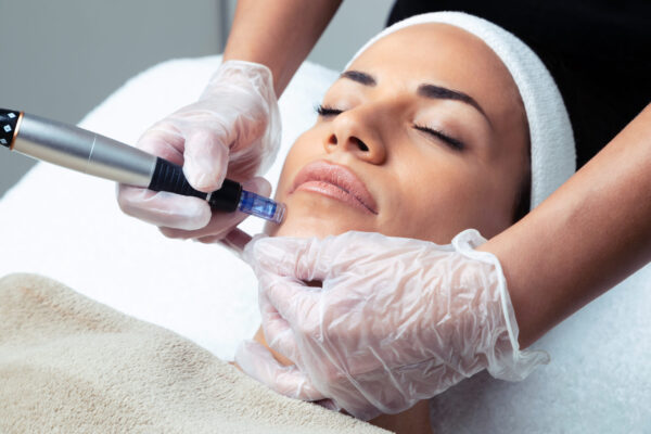 Microneedling with PRP