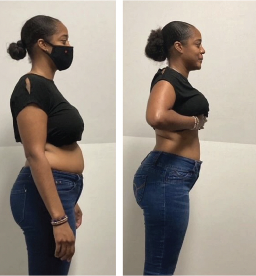 Before and After photo of woman with black top and blue jeans showing reduction in abdomen from invisa RED treatment